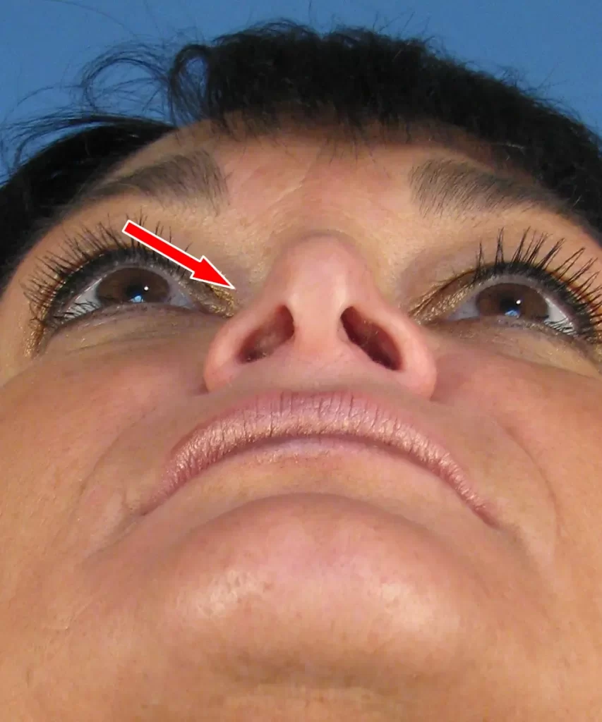 Close-up of a person's nose from a low angle, with an arrow pointing to the inside of the right nostril. The background is blue.