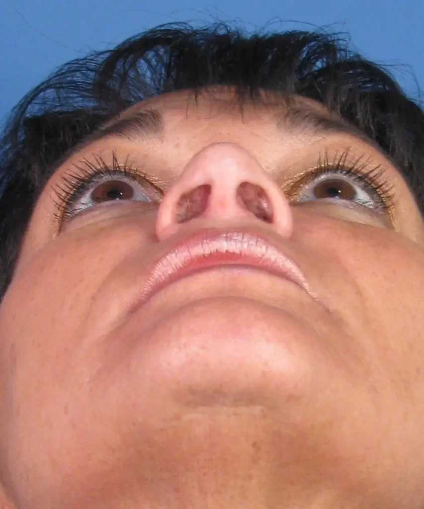Close-up of a person's upturned face showing a mole or skin blemish on the underside of the nose, with visible nostrils and eyelashes.