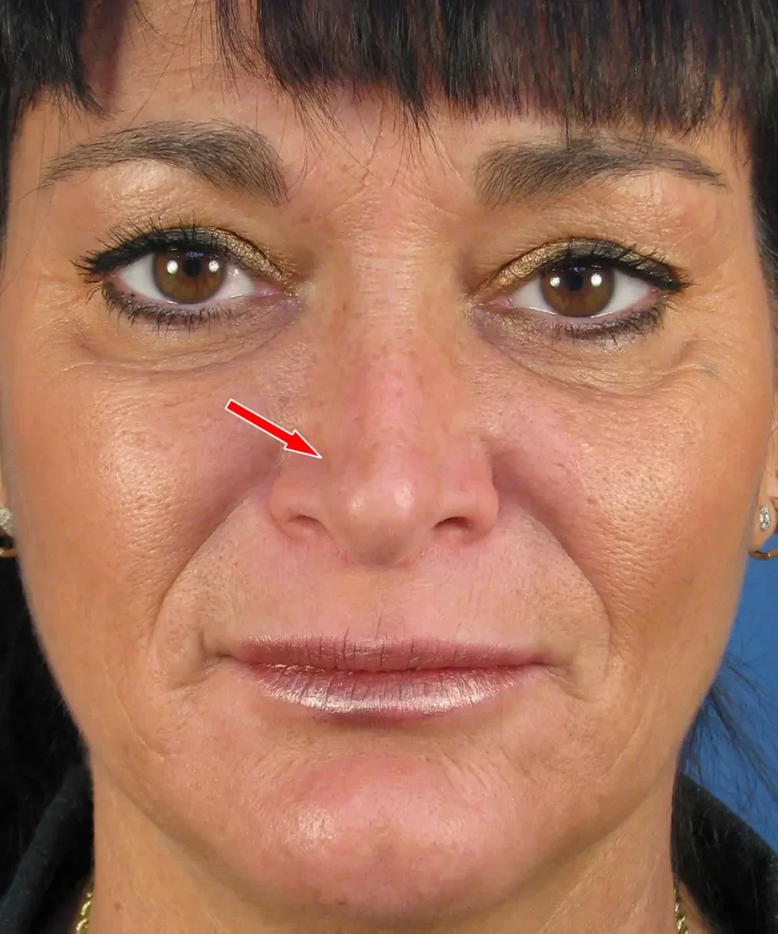 Close-up of a person’s face with a red arrow pointing to the nasolabial fold area beside the right nostril.