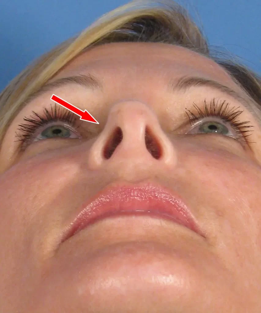 Close-up view of a person's face from below, highlighting the upper area of the nostrils with a red arrow.