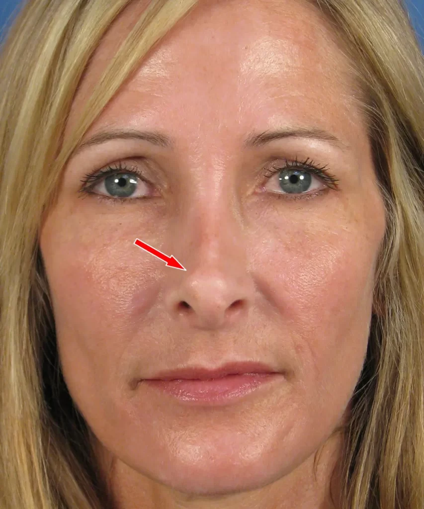 Close-up of a woman's face with a red arrow pointing to a small bump on her nose.