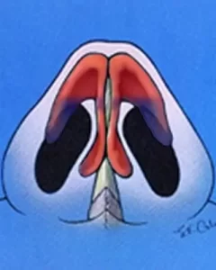 Illustration of nasal passages, showing colored sections representing sinus cavities and airflow pathways. Blue background highlights the anatomical structures.