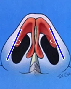 Diagram of a nose cross-section highlighting the nasal passages, turbinates, and septum with blue lines and circles.