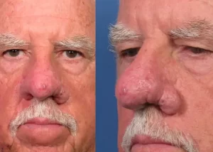 Close-up side-by-side images of an older man's face showing a red, swollen nose with prominent pores, against a blue background.