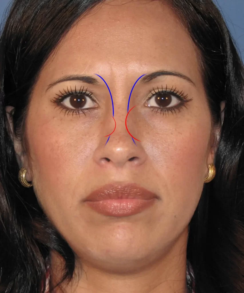 Close-up of a woman's face with contour lines on her nose, indicating potential areas for rhinoplasty adjustments.
