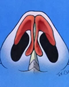 Anatomical illustration of a human nose, viewed from below, showing nasal cavity and structures in red and black against a blue background.