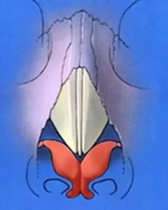 Illustration of a surgical procedure showing cutaway view of anatomical structures with red, white, and blue sections on a blue background.