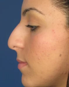 Profile view of a person's face with a prominent nose and visible acne marks on the cheek, set against a blue background.