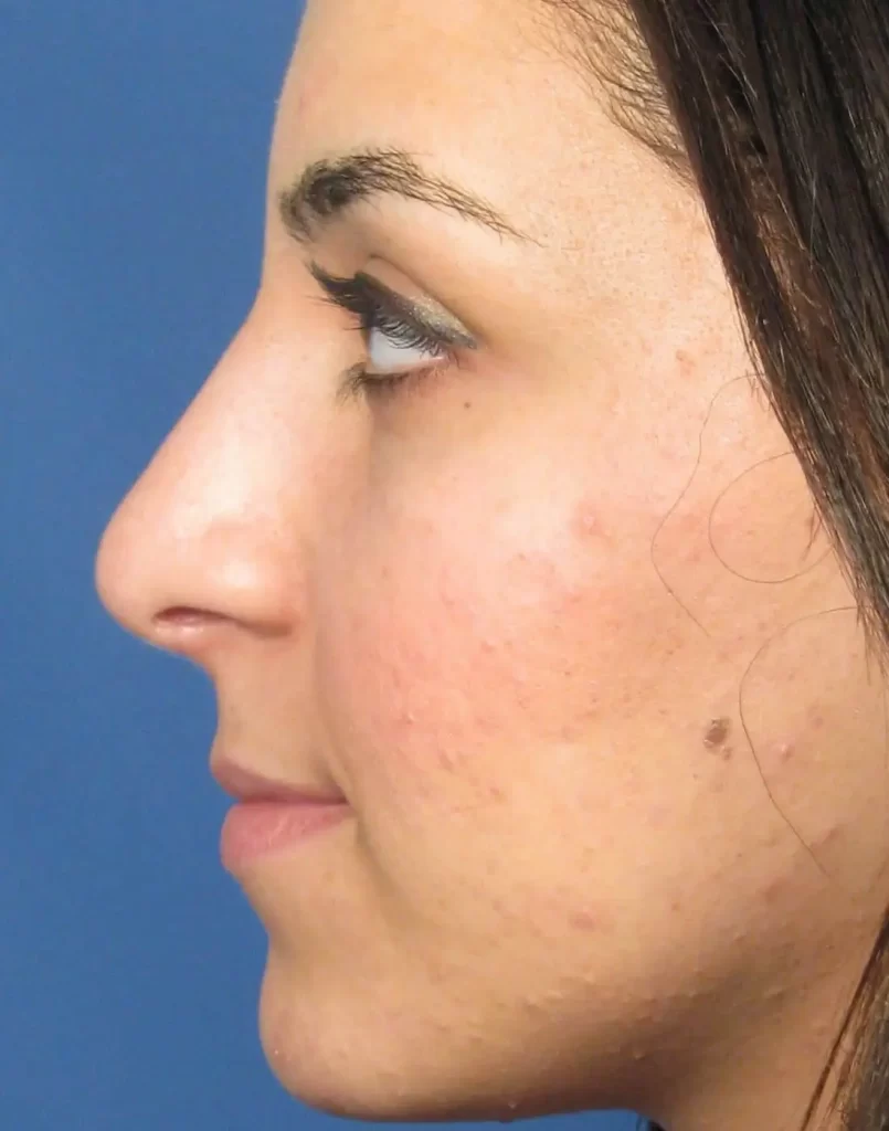 Profile view of a person with long dark hair and visible acne on the cheek against a blue background.