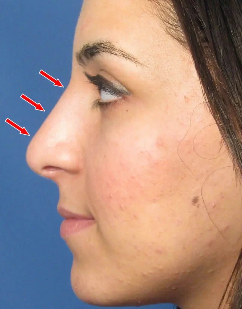 Side view of a woman's face with red arrows pointing to her nose, highlighting its profile.