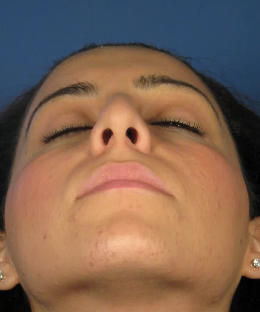 Close-up of a person's face from below, showing closed eyes and upward angle. The skin appears smooth with some blemishes on the chin and cheeks. Background is blue.