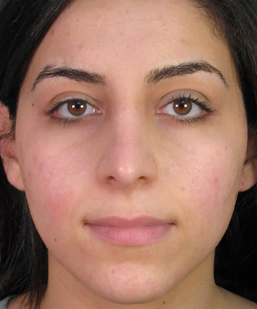 Close-up of a person with dark hair, neutral expression, and slight redness on cheeks against a plain background.