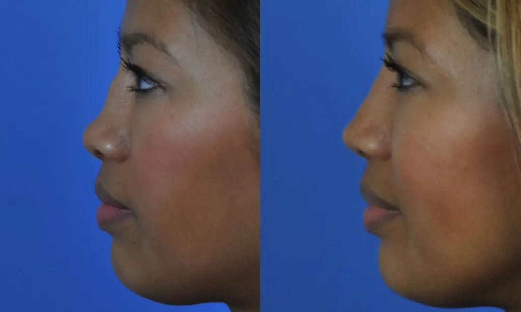 Side-by-side comparison of a woman's profile before and after a nose reshaping procedure against a blue background.