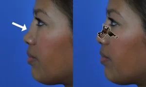 Saddle nose discount