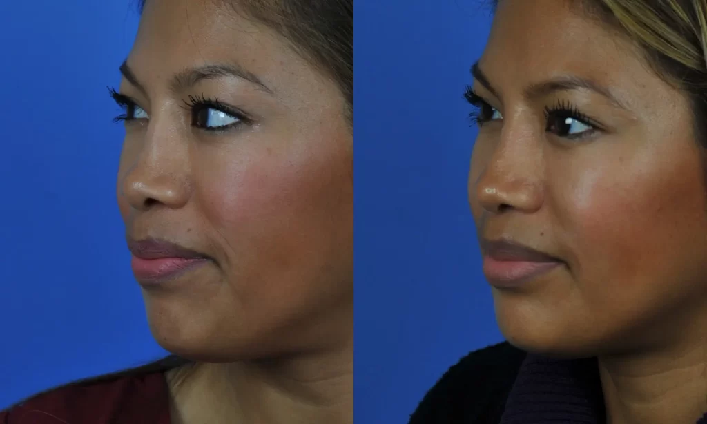 Two side-by-side profile photos of a woman against a blue background, showing her face from slightly different angles.