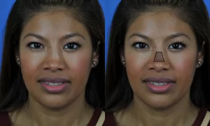 Side-by-side comparison of a woman's face, with the right image highlighting the nose area in a triangular shape.