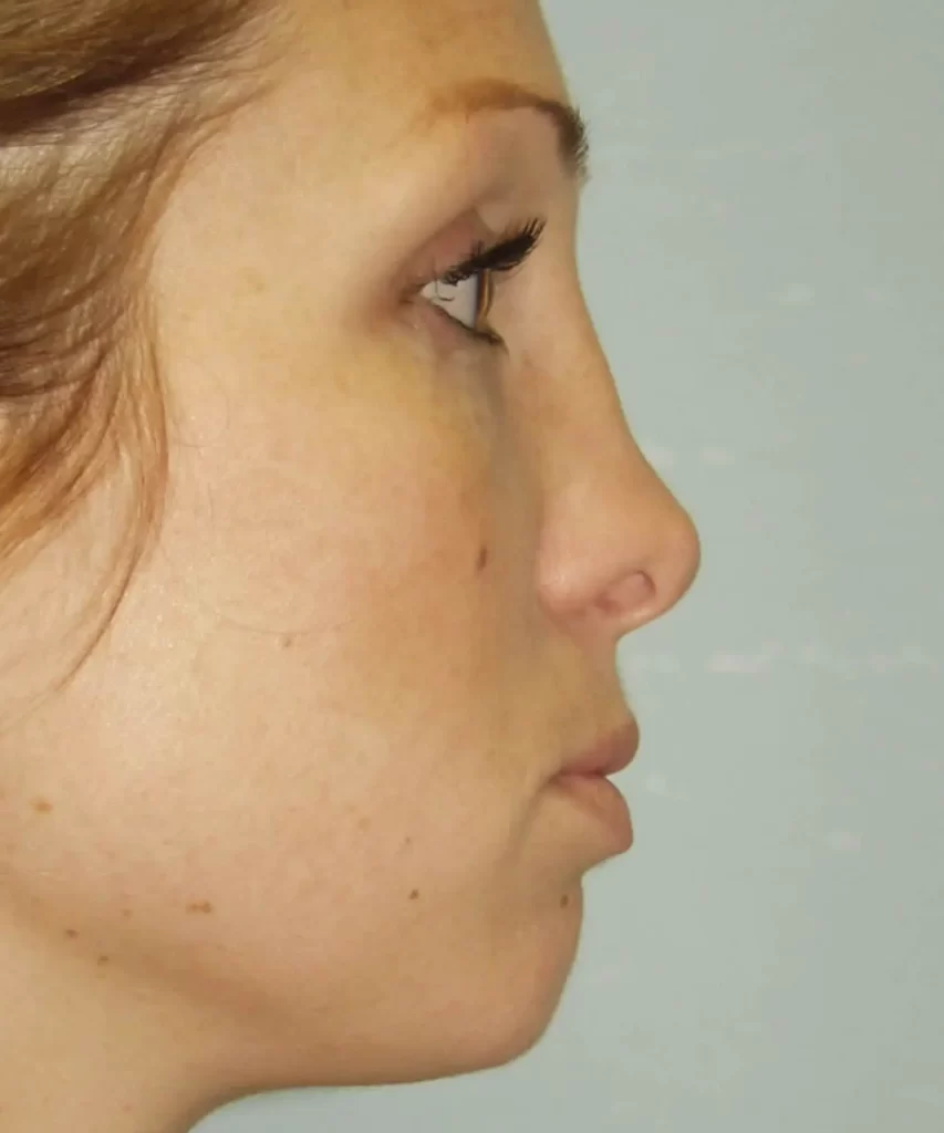 Side profile of a woman with medium-length hair, highlighting her nose and jawline against a plain background.
