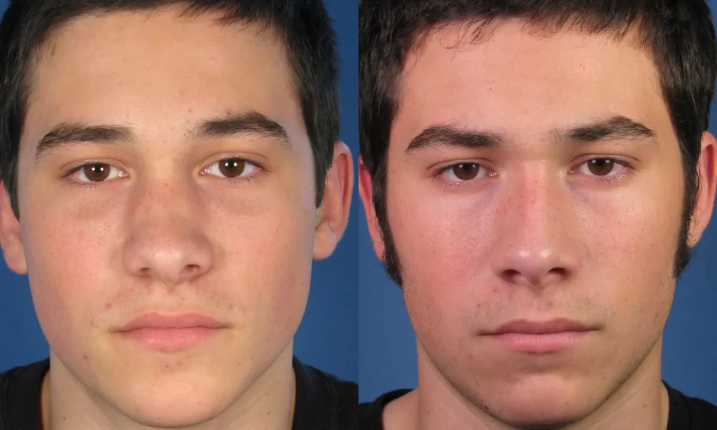 Side-by-side images of the same young man's face, showing slight variations in expression and angle.