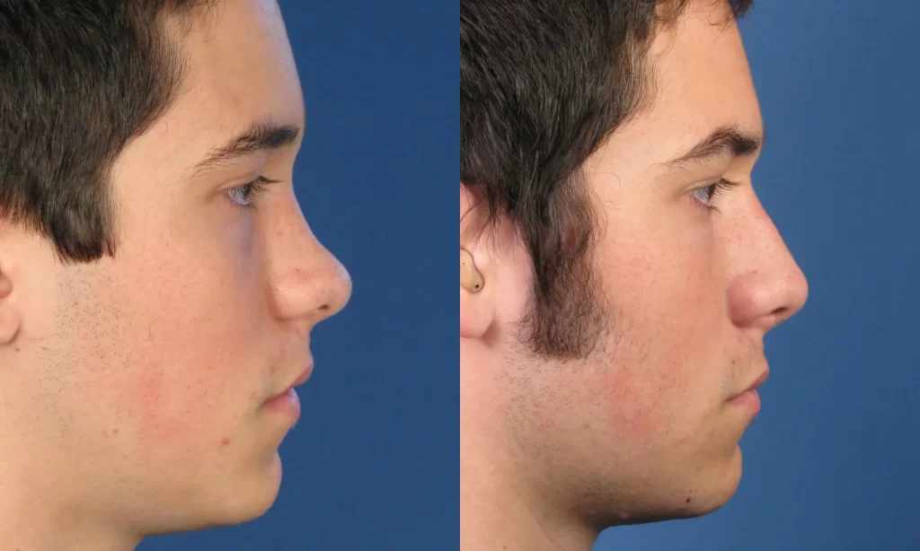 Side-by-side profile comparison of a person's face before and after a nose job, showing changes in the nose shape against a blue background.