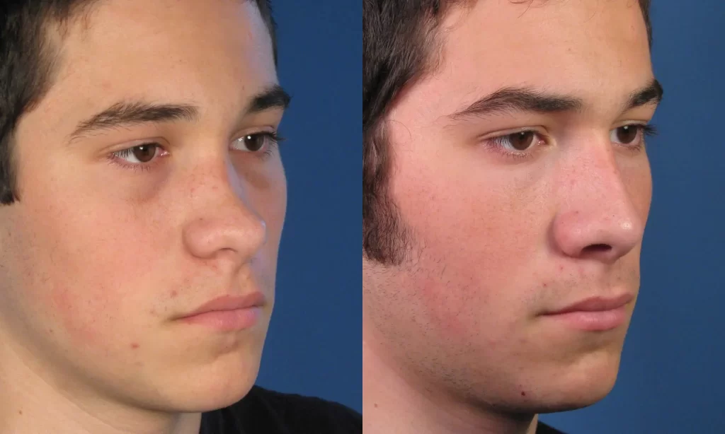 Side-by-side images show a young person looking forward and to the right against a blue background.