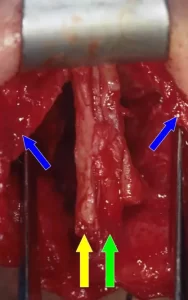 Close-up of surgical procedure showing tissue with two blue arrows, one yellow arrow, and one green arrow indicating specific areas.