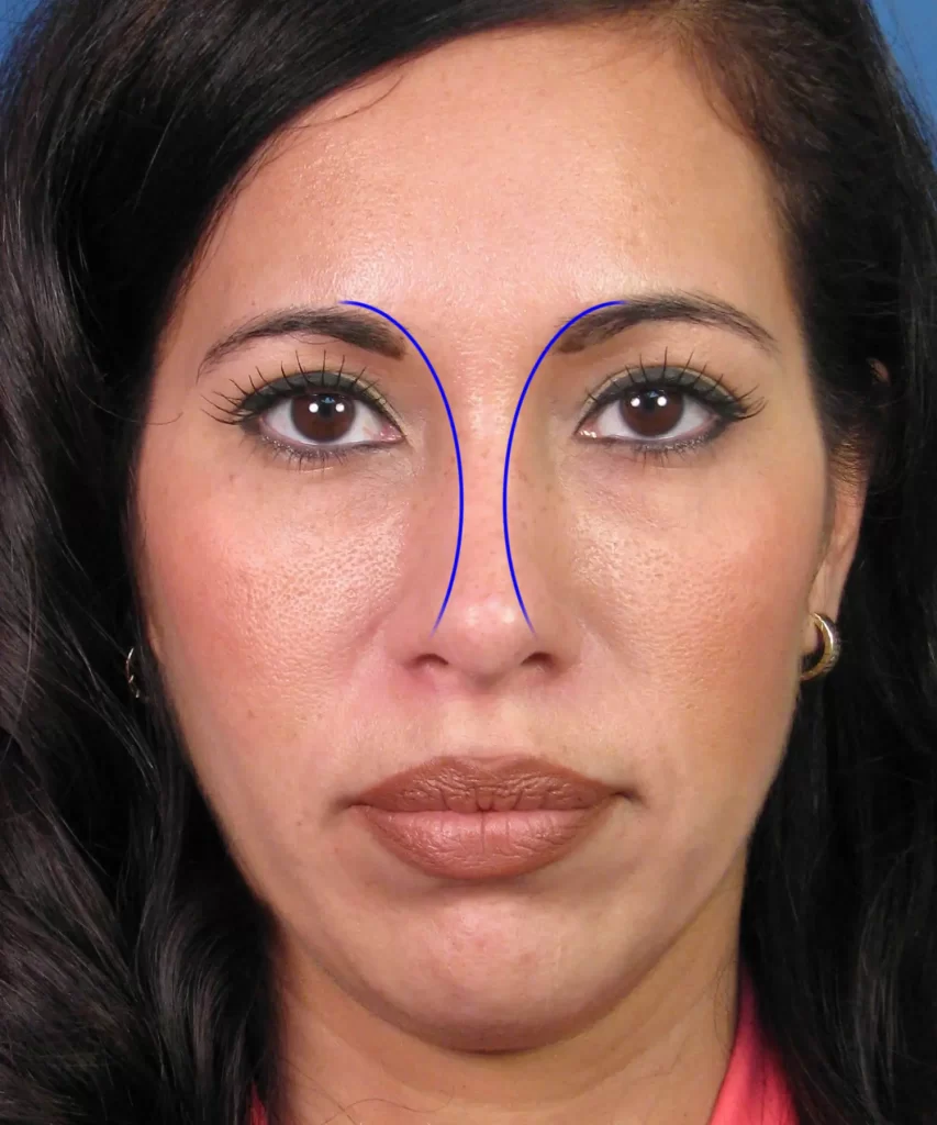 Close-up of a woman's face with two blue lines drawn from the eyebrows to the nose, demonstrating facial symmetry.