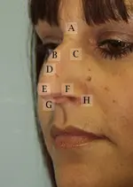 Profile view of a woman's face with sections labeled A to H, possibly illustrating areas for a medical or cosmetic procedure.