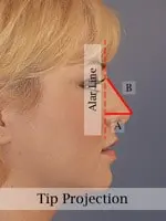 Profile view of a woman's face with overlaid diagram showing nasal tip projection, including an alar line and angles labeled A and B.