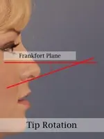 Profile view of a person's face with red lines indicating the Frankfort Plane and tip rotation angle on the nose.