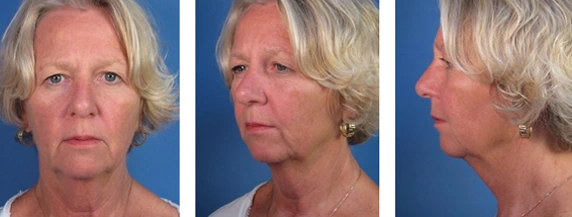 Three-panel image showing a woman with short blonde hair from front, three-quarter, and side profiles against a blue background.