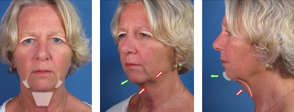 Three views of a woman before a cosmetic procedure, with markings on her face and neck indicating target areas.