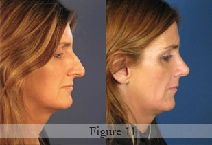 Side-by-side profile comparison of a woman showing her face before and after rhinoplasty surgery.