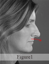 Profile view of a person with a downward arrow pointing to the nose.