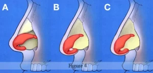 Diagram showing cross-sections of three nasal structures (A, B, C) with highlighted areas in red and yellow against a blue background.