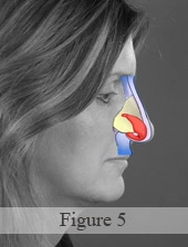 Profile of a person with a diagram highlighting sinus anatomy overlaid on the face.
