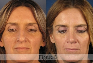 Comparison of a woman's face before and after a procedure, with slight changes in skin texture and facial appearance.