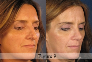 Side-by-side comparison of a woman's face showing subtle changes in skin tone and texture under different lighting.