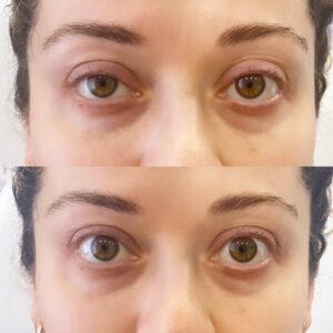 Before and after comparison of a person's eyes showing a difference in the appearance of the eyelids and under-eye area.