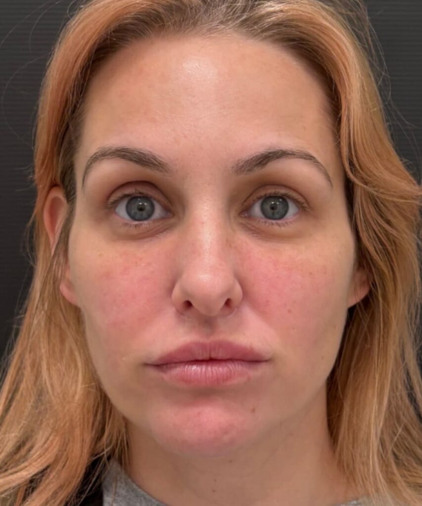 A patient after Ariessence procedure