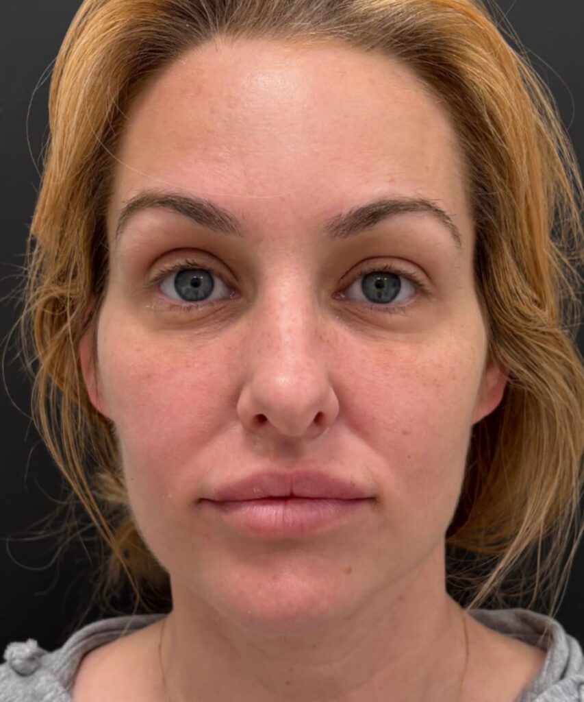 A patient before Ariessence procedure