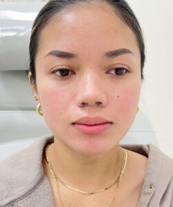 After frontal