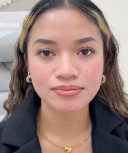 Before frontal