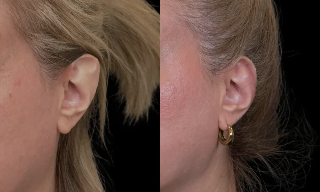 Stahl Otoplasty patient before and after