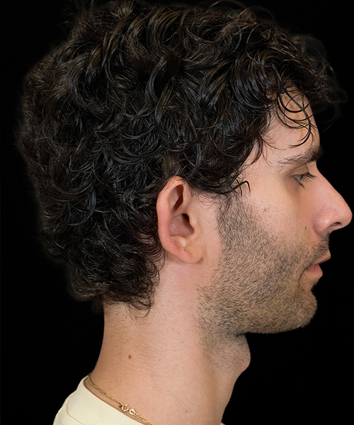 Before Side 1