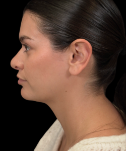 Before Left Lateral