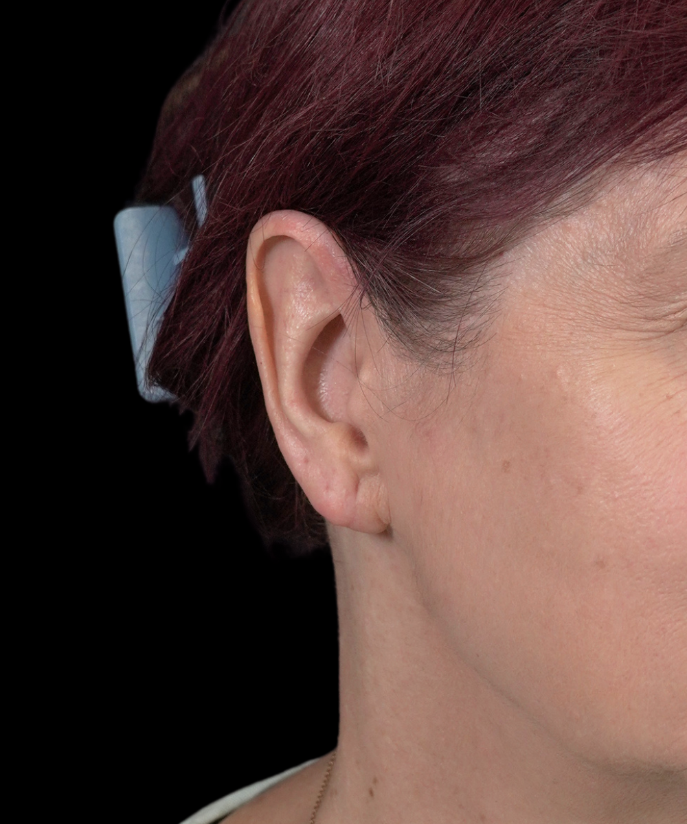 After Oblique 1
