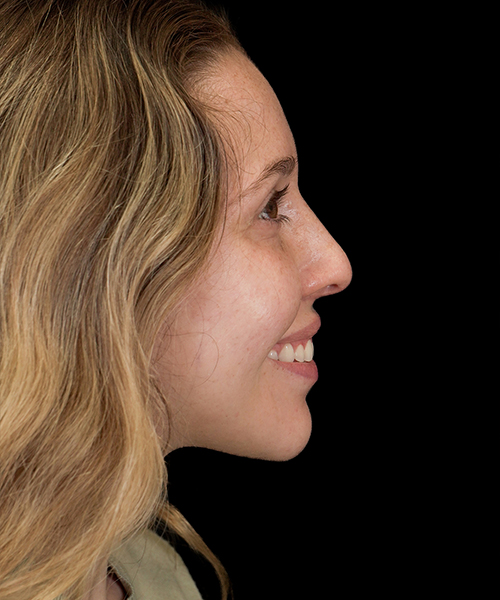 Before Smiling 1
