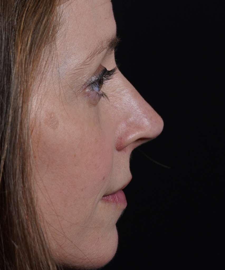 After lateral