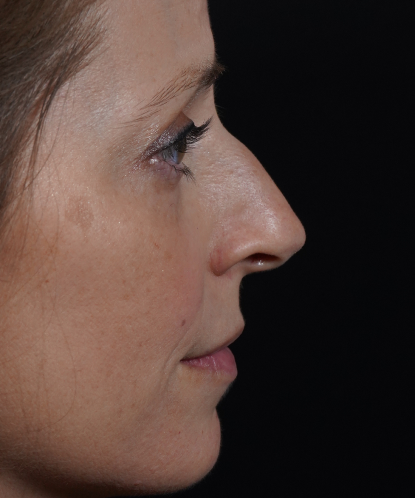 Before lateral