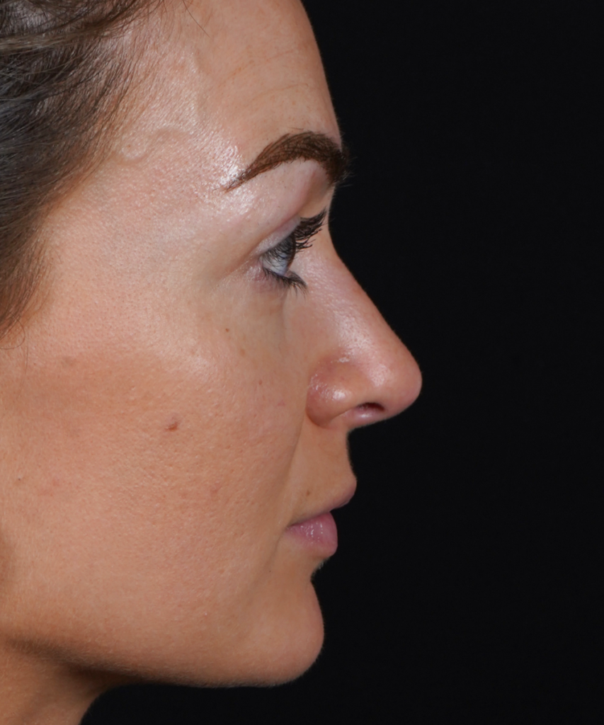 After lateral